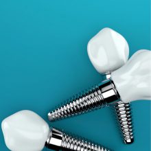 İmplant Diş Tedavisi Nasıl Yapılır?
